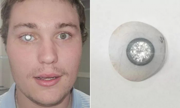 Американец вживил в свой искусственный глаз бриллиант весом в два карата