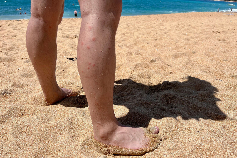 В Китае вспышка лихорадки чикунгунья. В Кыргызстане случаи пока не зафиксированы
