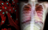 Минздрав: Проблемы фиброза легких после внебольничной пневмонии не существует