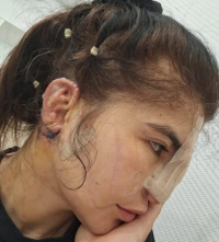 Асель Ногойбаевой провели операцию по восстановлению уха